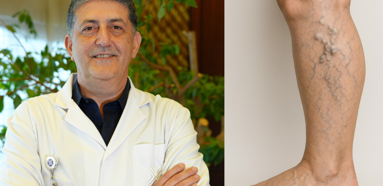 Özellikle kadınlarda görülüyor! Varis artık sorun değil bu yöntemle hızlıca iyileşmek mümkün